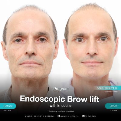 Endoscopic Brow Lift before and after results at Wansiri Hospital Bangkok