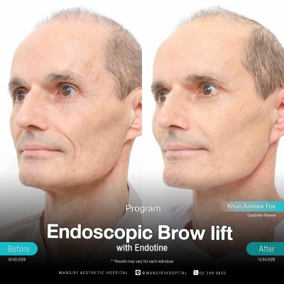 Endoscopic Brow Lift before and after results at Wansiri Hospital Bangkok
