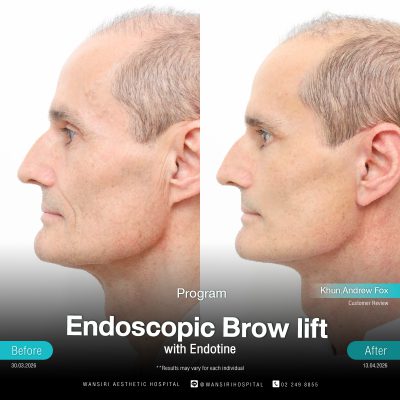 Endoscopic Brow Lift before and after results at Wansiri Hospital Bangkok
