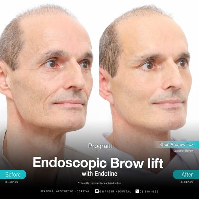 Endoscopic Brow Lift before and after results at Wansiri Hospital Bangkok