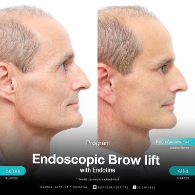 Endoscopic Brow Lift before and after results at Wansiri Hospital Bangkok