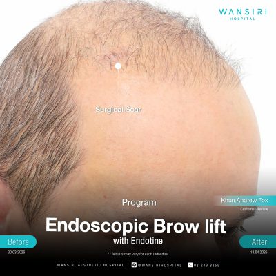 Endoscopic Brow Lift before and after results at Wansiri Hospital Bangkok