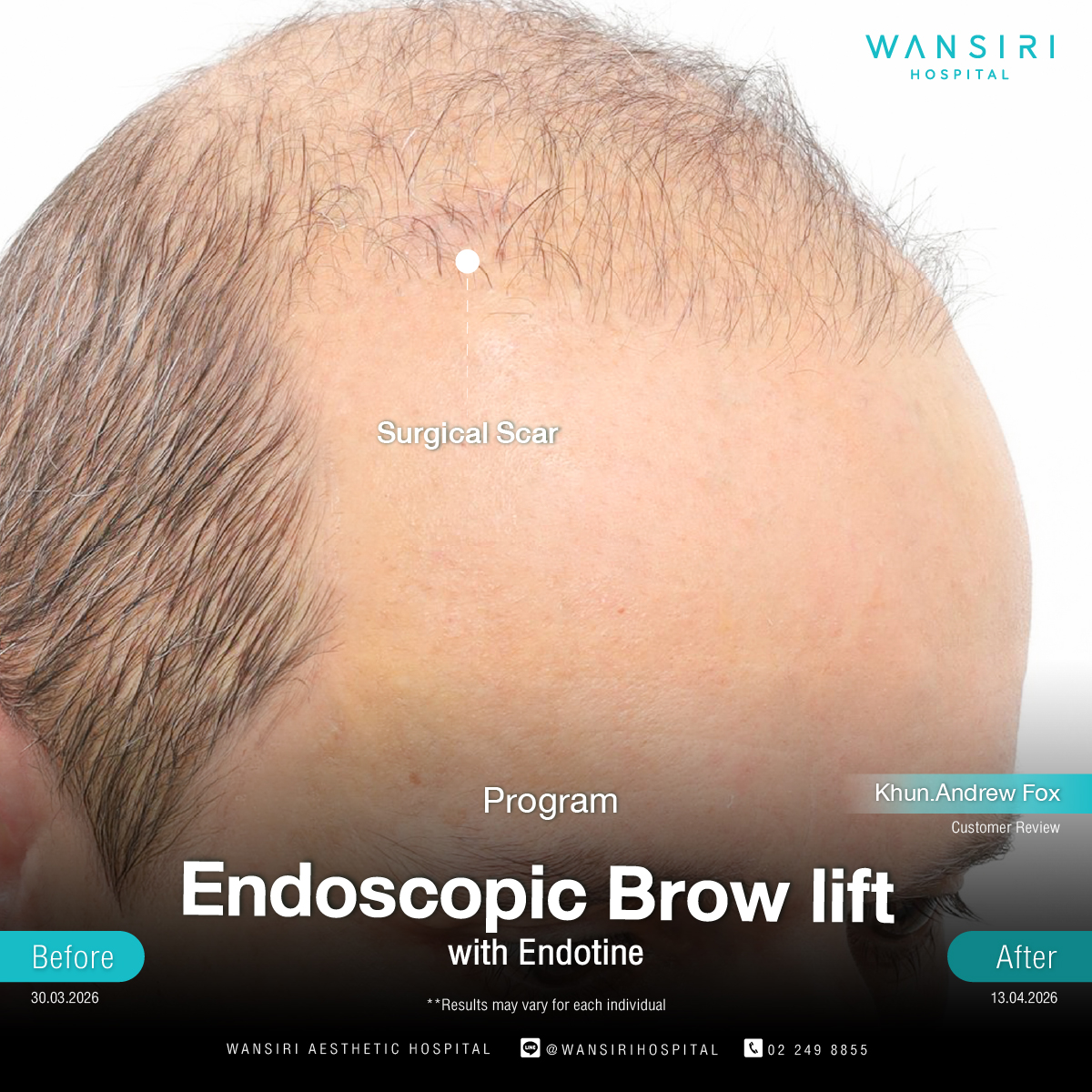 Endoscopic Brow Lift before and after results at Wansiri Hospital Bangkok