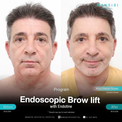 Endoscopic Brow Lift before and after results at Wansiri Hospital Bangkok