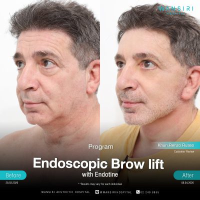 Endoscopic Brow Lift before and after results at Wansiri Hospital Bangkok