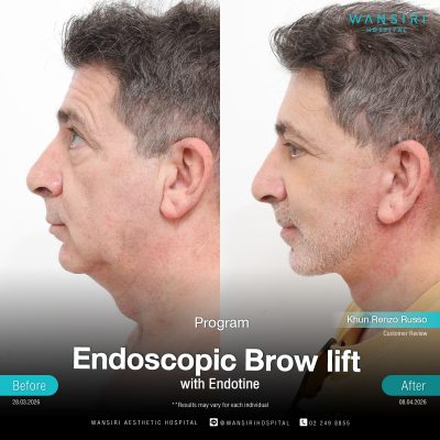 Endoscopic Brow Lift before and after results at Wansiri Hospital Bangkok