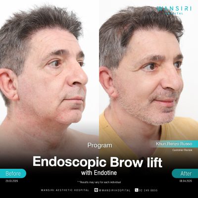 Endoscopic Brow Lift before and after results at Wansiri Hospital Bangkok