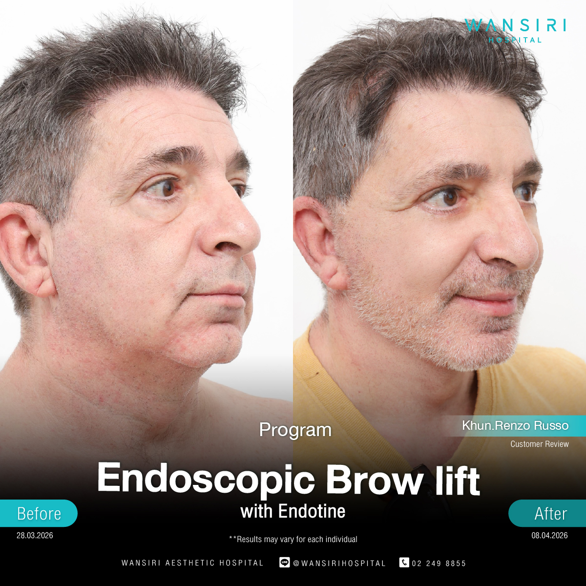 Endoscopic Brow Lift before and after results at Wansiri Hospital Bangkok