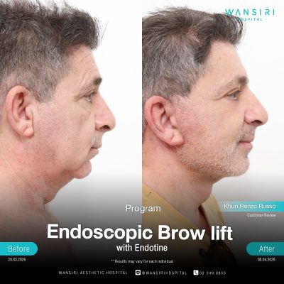 Endoscopic Brow Lift before and after results at Wansiri Hospital Bangkok