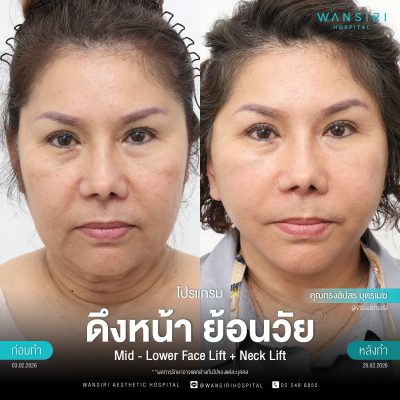 ดึงหน้า, ดึงหน้า ชั้นลึก, Face Lift, Deep Plane Facelift, Neck Lift