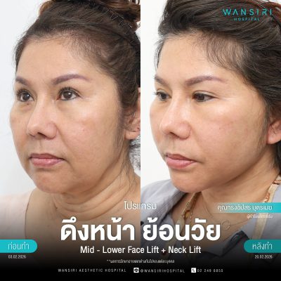 ดึงหน้า, ดึงหน้า ชั้นลึก, Face Lift, Deep Plane Facelift, Neck Lift