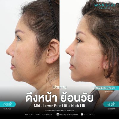 ดึงหน้า, ดึงหน้า ชั้นลึก, Face Lift, Deep Plane Facelift, Neck Lift
