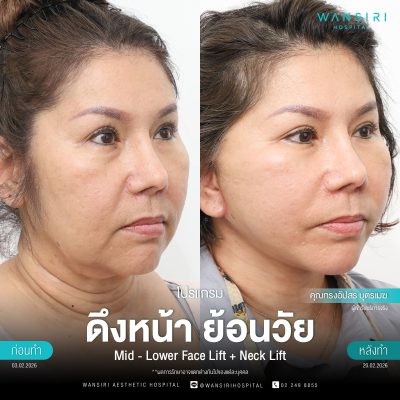 ดึงหน้า, ดึงหน้า ชั้นลึก, Face Lift, Deep Plane Facelift, Neck Lift