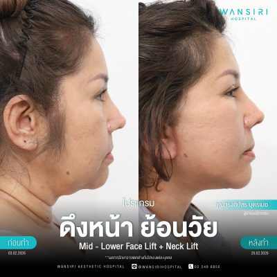 ดึงหน้า, ดึงหน้า ชั้นลึก, Face Lift, Deep Plane Facelift, Neck Lift