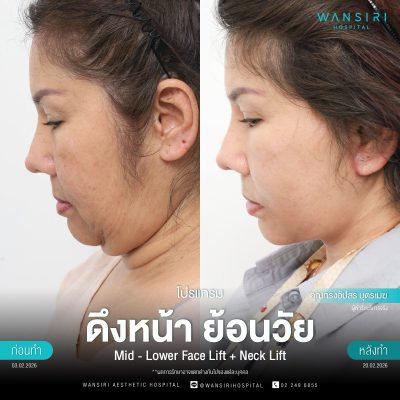 ดึงหน้า, ดึงหน้า ชั้นลึก, Face Lift, Deep Plane Facelift, Neck Lift