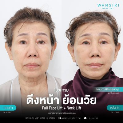 ดึงหน้า, ดึงหน้า ชั้นลึก, Face Lift, Deep Plane Facelift, Neck Lift