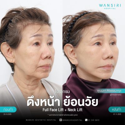 ดึงหน้า, ดึงหน้า ชั้นลึก, Face Lift, Deep Plane Facelift, Neck Lift