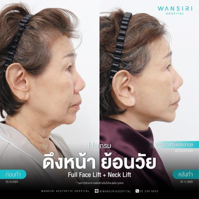 ดึงหน้า, ดึงหน้า ชั้นลึก, Face Lift, Deep Plane Facelift, Neck Lift