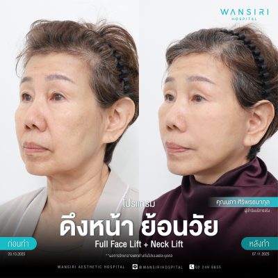 ดึงหน้า, ดึงหน้า ชั้นลึก, Face Lift, Deep Plane Facelift, Neck Lift