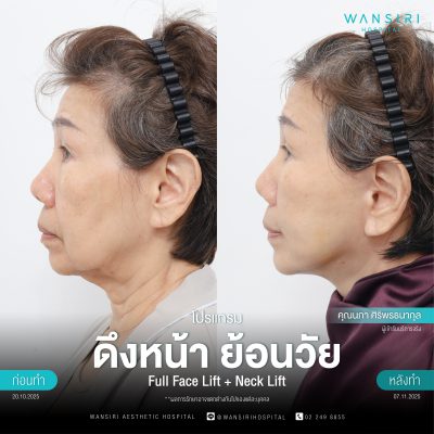 ดึงหน้า, ดึงหน้า ชั้นลึก, Face Lift, Deep Plane Facelift, Neck Lift