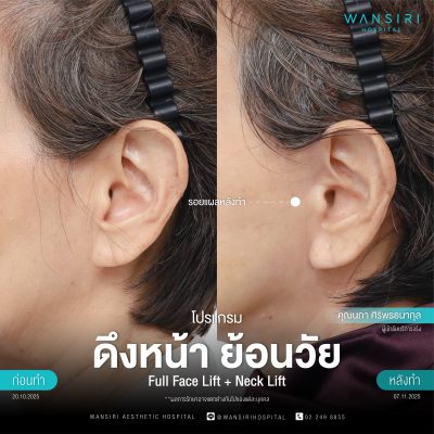 ดึงหน้า, ดึงหน้า ชั้นลึก, Face Lift, Deep Plane Facelift, Neck Lift