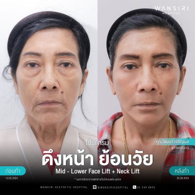 ดึงหน้า, ดึงหน้า ชั้นลึก, Face Lift, Deep Plane Facelift, Neck Lift