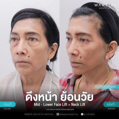 ดึงหน้า, ดึงหน้า ชั้นลึก, Face Lift, Deep Plane Facelift, Neck Lift