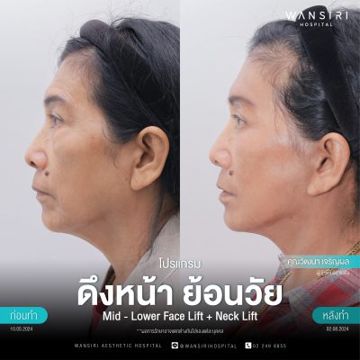 ดึงหน้า, ดึงหน้า ชั้นลึก, Face Lift, Deep Plane Facelift, Neck Lift