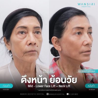 ดึงหน้า, ดึงหน้า ชั้นลึก, Face Lift, Deep Plane Facelift, Neck Lift