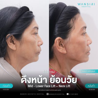 ดึงหน้า, ดึงหน้า ชั้นลึก, Face Lift, Deep Plane Facelift, Neck Lift