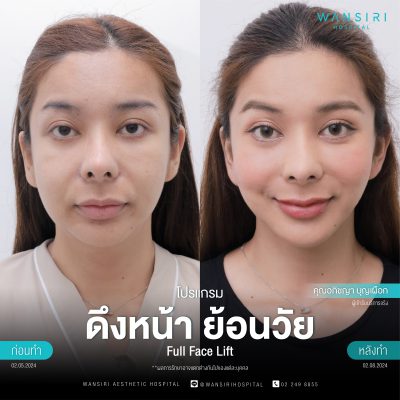 ดึงหน้า, ดึงหน้า ชั้นลึก, Face Lift, Deep Plane Facelift, Neck Lift