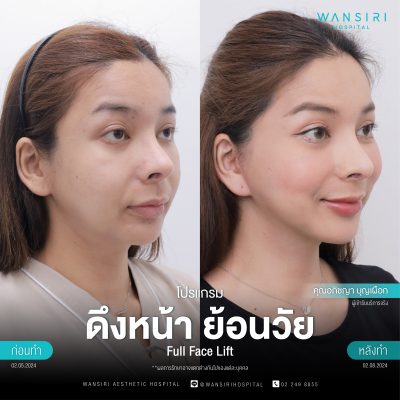 ดึงหน้า, ดึงหน้า ชั้นลึก, Face Lift, Deep Plane Facelift, Neck Lift