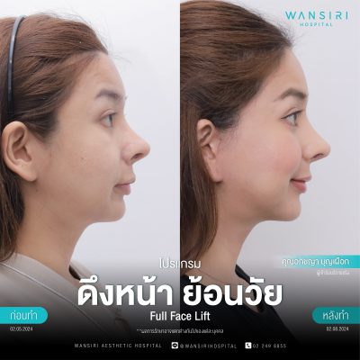 ดึงหน้า, ดึงหน้า ชั้นลึก, Face Lift, Deep Plane Facelift, Neck Lift
