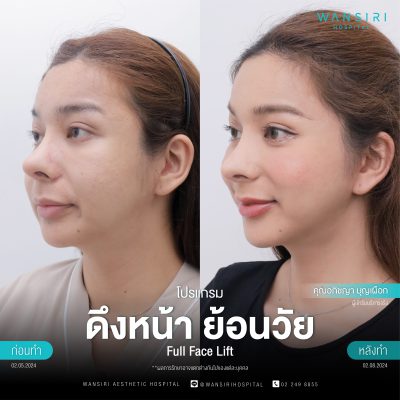 ดึงหน้า, ดึงหน้า ชั้นลึก, Face Lift, Deep Plane Facelift, Neck Lift