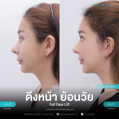 ดึงหน้า, ดึงหน้า ชั้นลึก, Face Lift, Deep Plane Facelift, Neck Lift