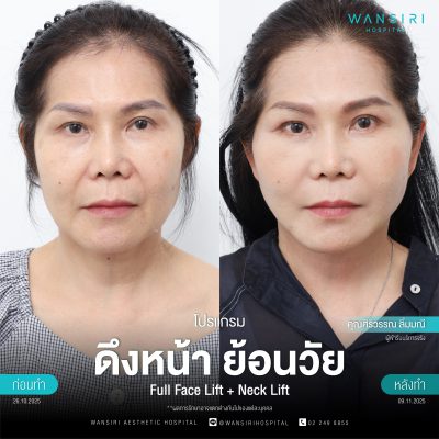 ดึงหน้า, ดึงหน้า ชั้นลึก, Face Lift, Deep Plane Facelift, Neck Lift