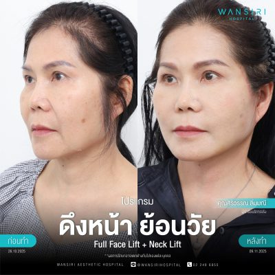 ดึงหน้า, ดึงหน้า ชั้นลึก, Face Lift, Deep Plane Facelift, Neck Lift