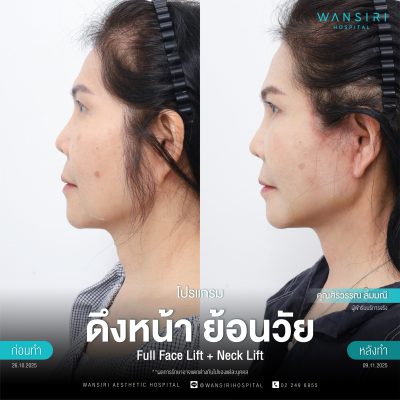 ดึงหน้า, ดึงหน้า ชั้นลึก, Face Lift, Deep Plane Facelift, Neck Lift