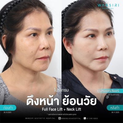 ดึงหน้า, ดึงหน้า ชั้นลึก, Face Lift, Deep Plane Facelift, Neck Lift