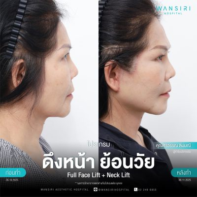 ดึงหน้า, ดึงหน้า ชั้นลึก, Face Lift, Deep Plane Facelift, Neck Lift