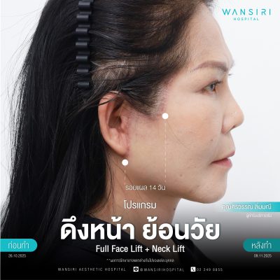 ดึงหน้า, ดึงหน้า ชั้นลึก, Face Lift, Deep Plane Facelift, Neck Lift