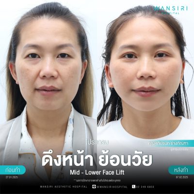 ดึงหน้า, ดึงหน้า ชั้นลึก, Face Lift, Deep Plane Facelift, Neck Lift