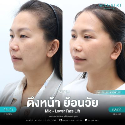 ดึงหน้า, ดึงหน้า ชั้นลึก, Face Lift, Deep Plane Facelift, Neck Lift