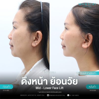 ดึงหน้า, ดึงหน้า ชั้นลึก, Face Lift, Deep Plane Facelift, Neck Lift