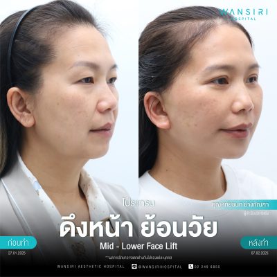 ดึงหน้า, ดึงหน้า ชั้นลึก, Face Lift, Deep Plane Facelift, Neck Lift