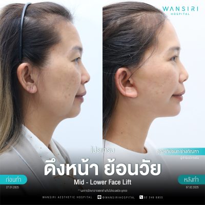 ดึงหน้า, ดึงหน้า ชั้นลึก, Face Lift, Deep Plane Facelift, Neck Lift