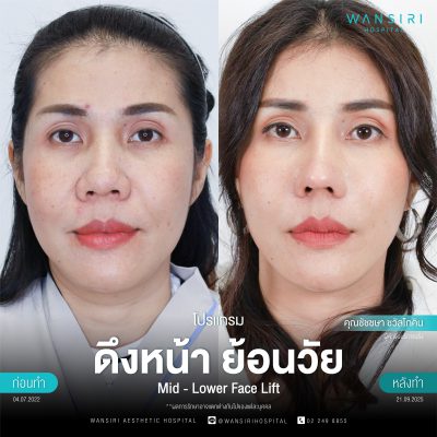 ดึงหน้า, ดึงหน้า ชั้นลึก, Face Lift, Deep Plane Facelift, Neck Lift