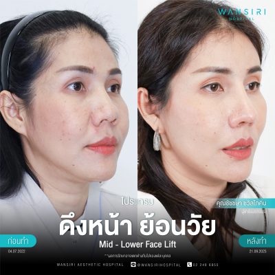 ดึงหน้า, ดึงหน้า ชั้นลึก, Face Lift, Deep Plane Facelift, Neck Lift