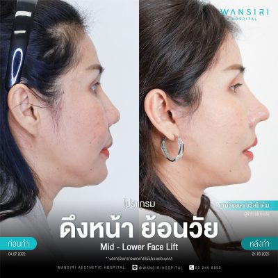 ดึงหน้า, ดึงหน้า ชั้นลึก, Face Lift, Deep Plane Facelift, Neck Lift