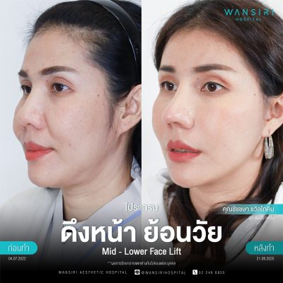 ดึงหน้า, ดึงหน้า ชั้นลึก, Face Lift, Deep Plane Facelift, Neck Lift